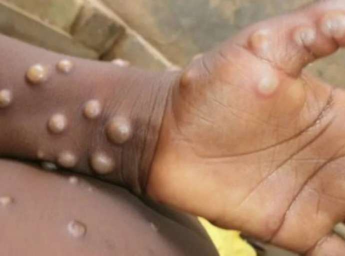 OMS diz que situação epidemiológica da varíola dos macacos no Brasil é “preocupante”